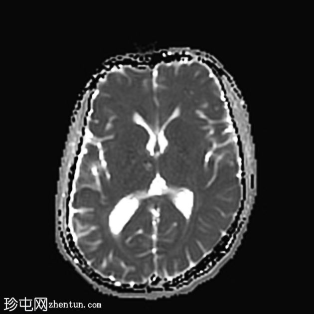 多发性脑海绵状血管瘤