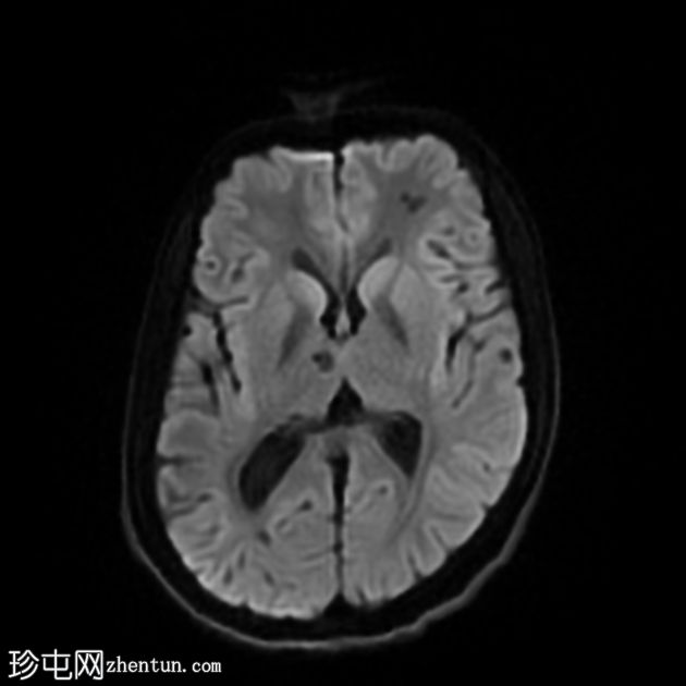 多发性脑海绵状血管瘤