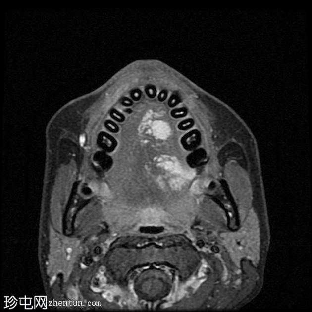 口腔血管瘤