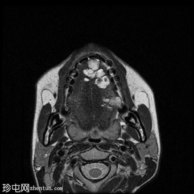 口腔血管瘤