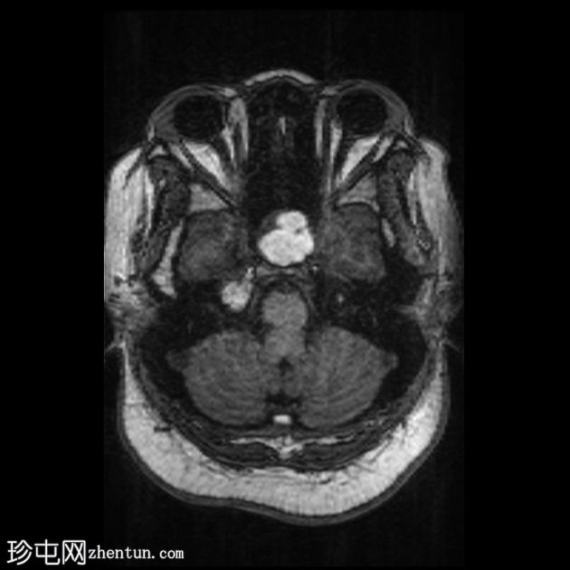 垂体大腺瘤伴中风