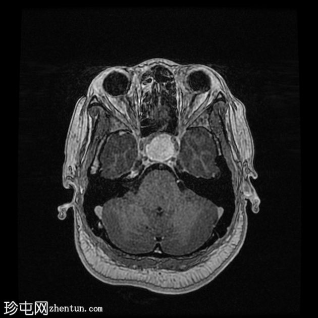 垂体大腺瘤伴中风