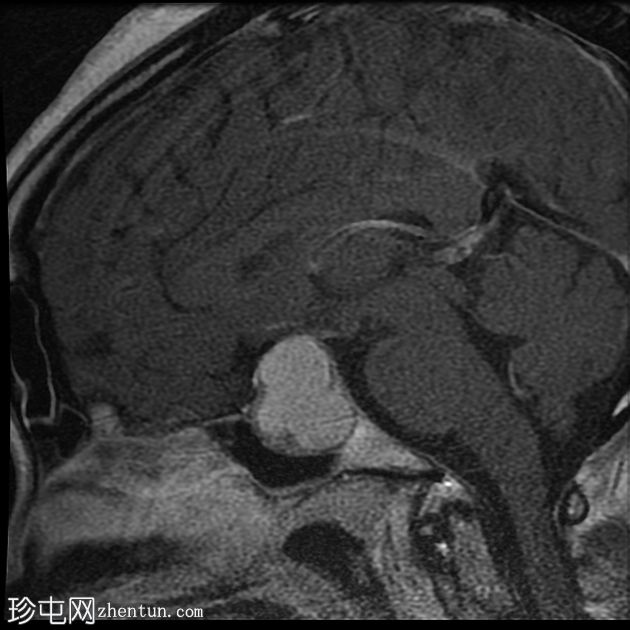 垂体大腺瘤伴中风