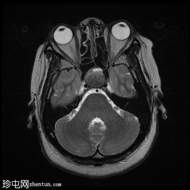 垂体大腺瘤伴中风