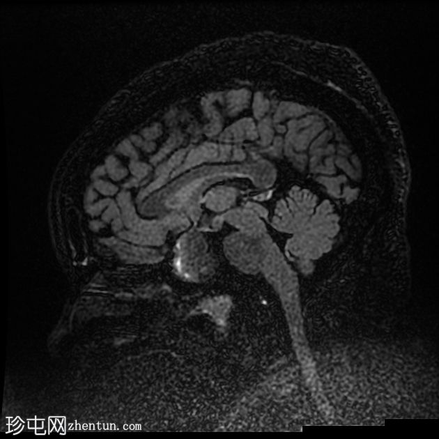 垂体大腺瘤伴中风