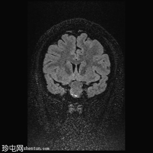 垂体大腺瘤伴中风