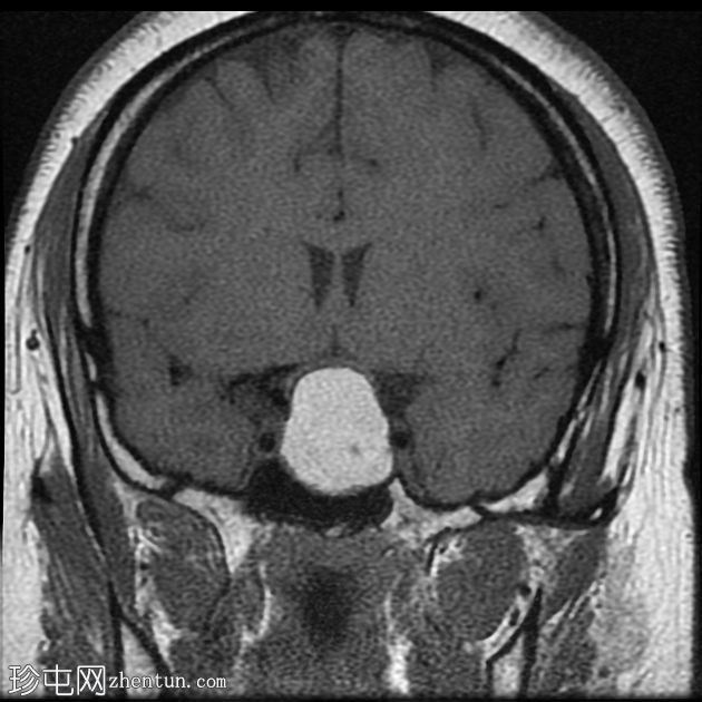 垂体大腺瘤伴中风