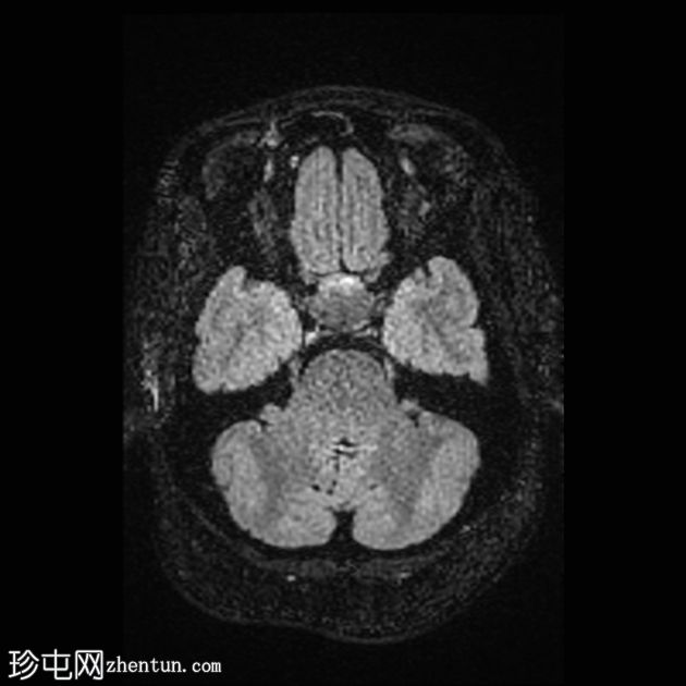 垂体大腺瘤伴中风