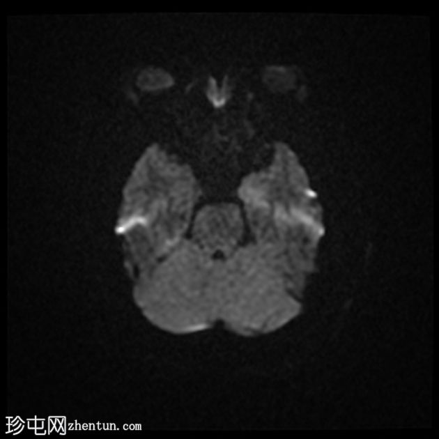 垂体大腺瘤伴中风