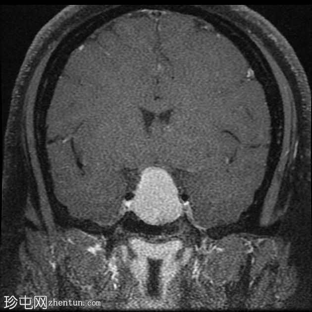 垂体大腺瘤伴中风