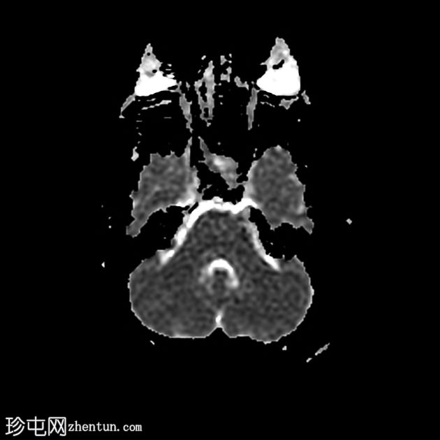 垂体大腺瘤伴中风