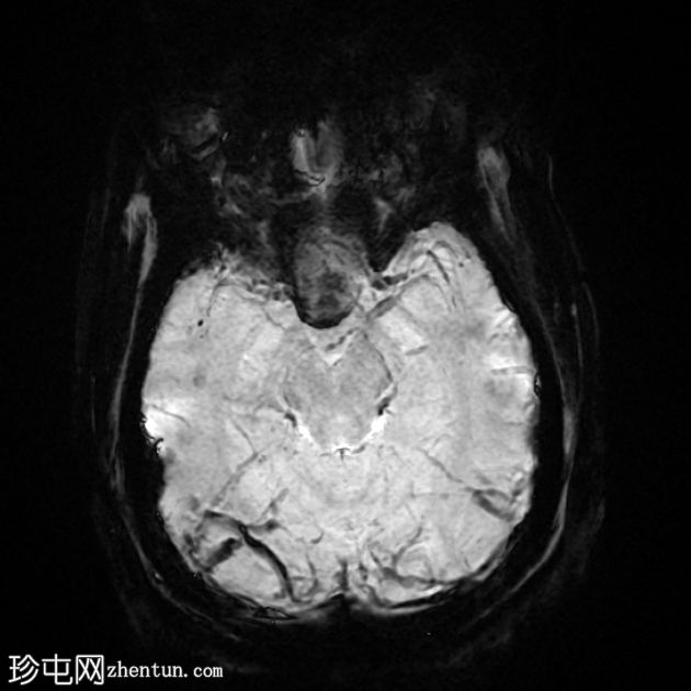 垂体大腺瘤伴中风