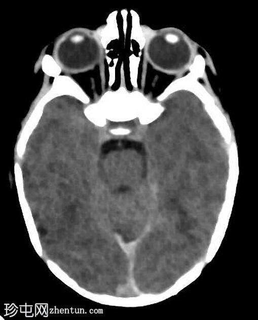 正常新生儿CT头