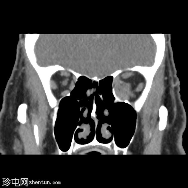 眼眶淋巴瘤