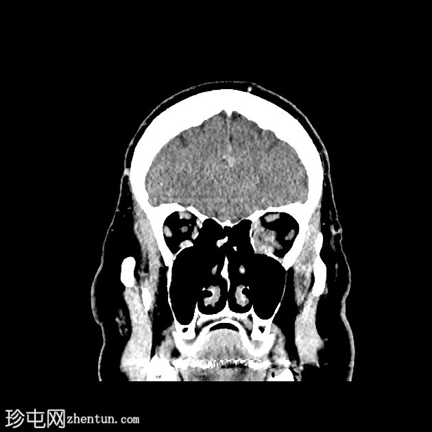 眼眶淋巴瘤