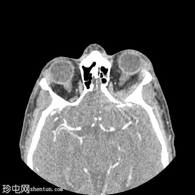 眼眶芽生菌病