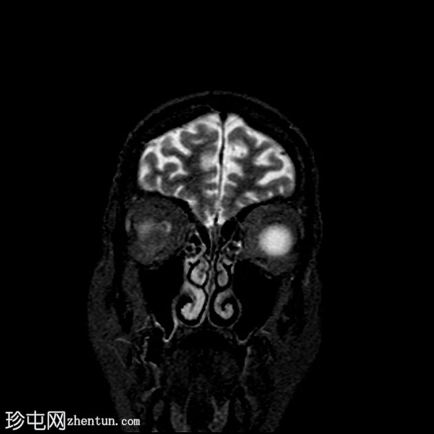 脉络膜黑色素瘤