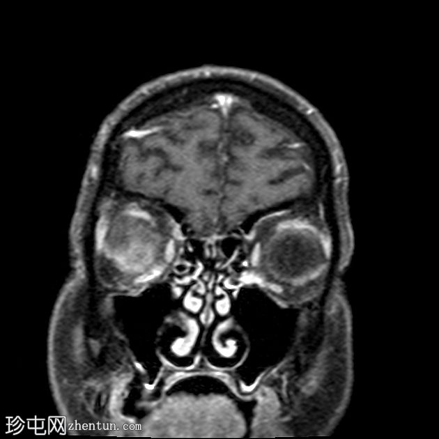 脉络膜黑色素瘤