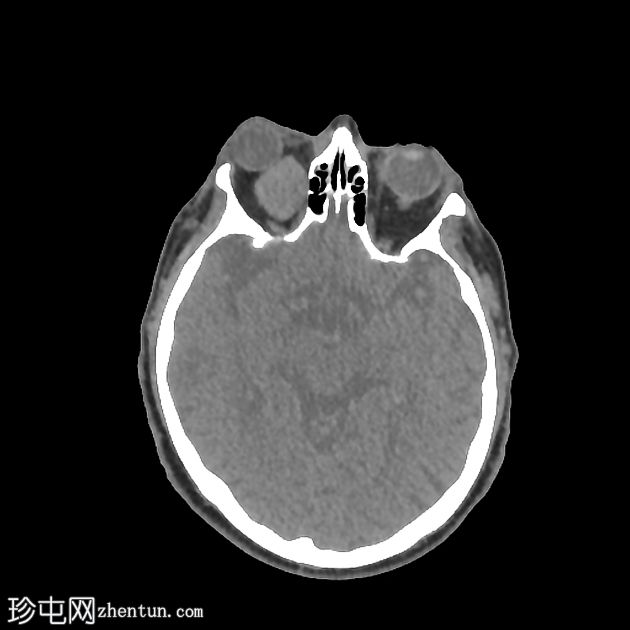 转移性黑色素瘤到眼眶