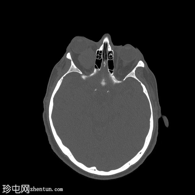 转移性黑色素瘤到眼眶