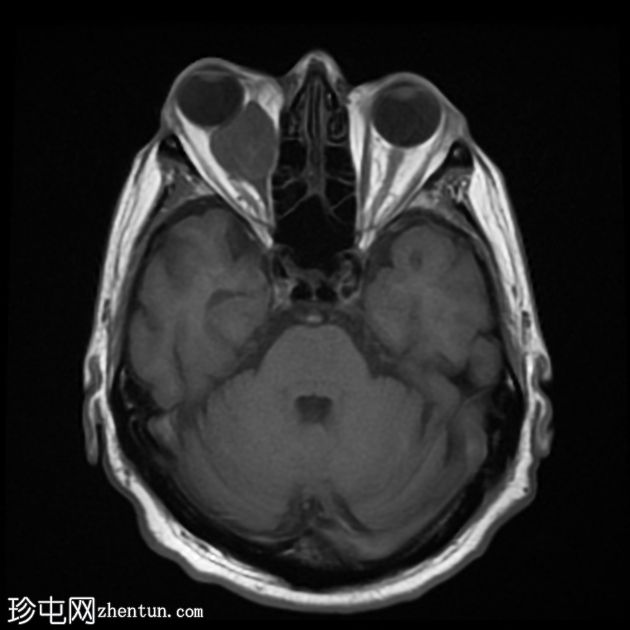 转移性黑色素瘤到眼眶