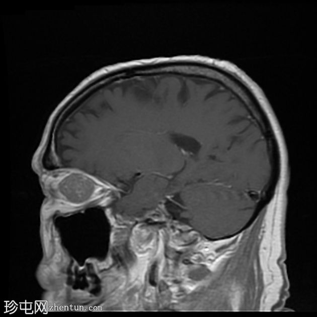 转移性黑色素瘤到眼眶