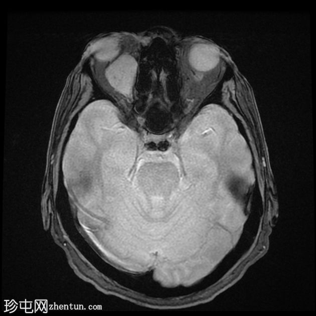 转移性黑色素瘤到眼眶