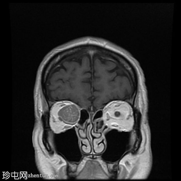 转移性黑色素瘤到眼眶