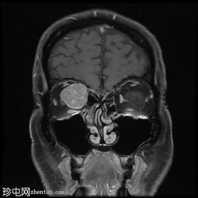 转移性黑色素瘤到眼眶