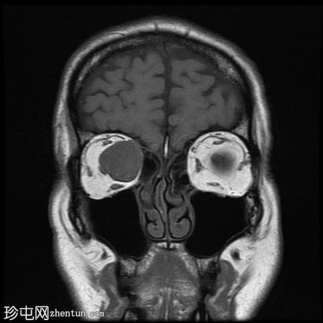 转移性黑色素瘤到眼眶