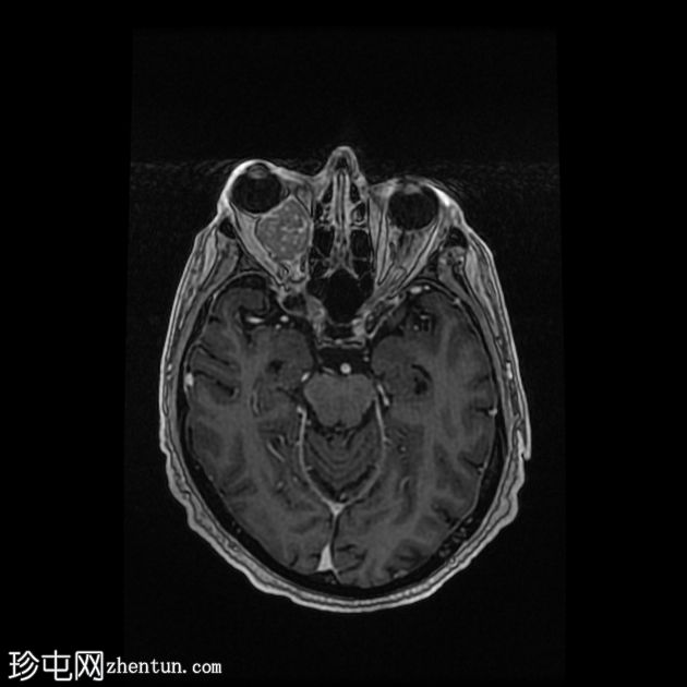 转移性黑色素瘤到眼眶