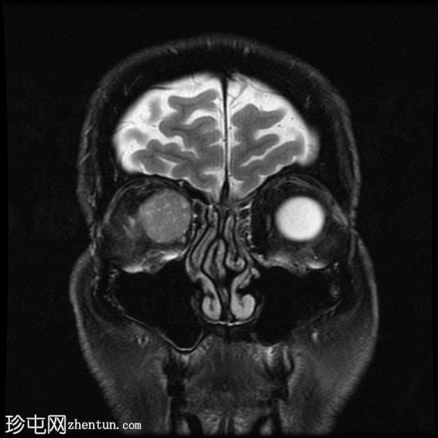 转移性黑色素瘤到眼眶