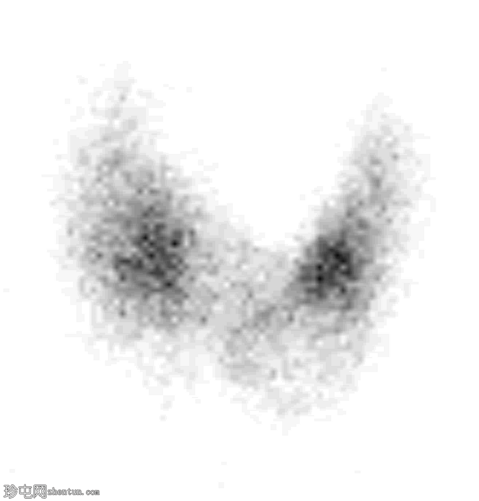 甲状腺闪烁显像上的冷结节