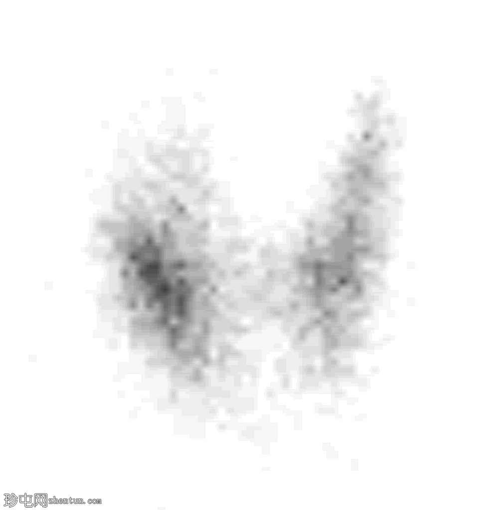 甲状腺闪烁显像上的冷结节
