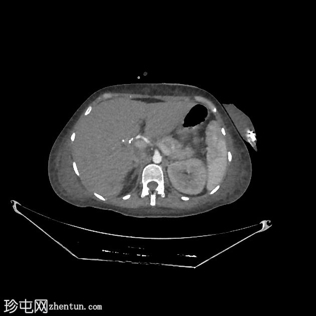 胆总管损伤和医源性胆总管梗阻