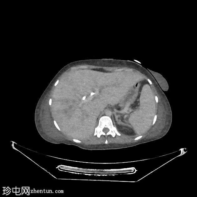 胆总管损伤和医源性胆总管梗阻