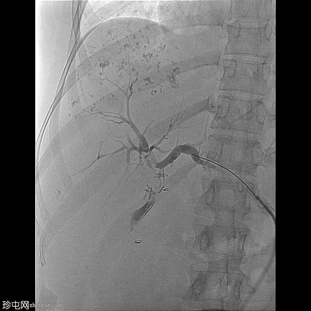 胆总管损伤和医源性胆总管梗阻