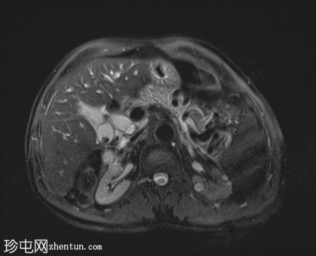 急性胰腺炎 (MRCP)