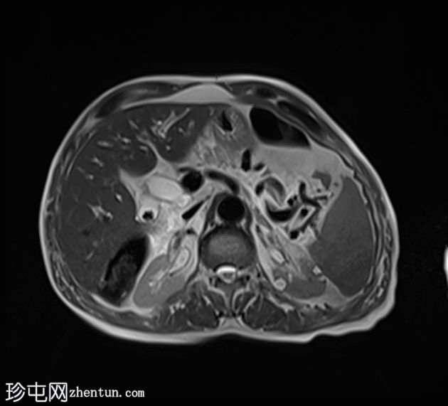 急性胰腺炎 (MRCP)