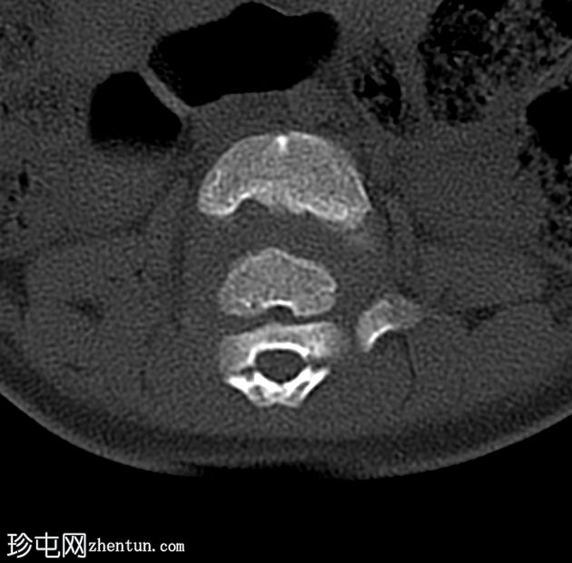 节段性脊柱发育不全