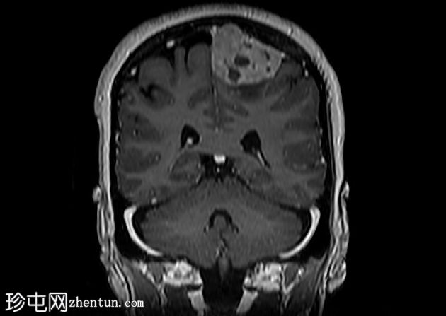 脑膜瘤 - 顶叶凸面