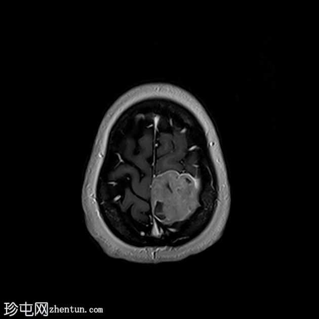 脑膜瘤 - 顶叶凸面