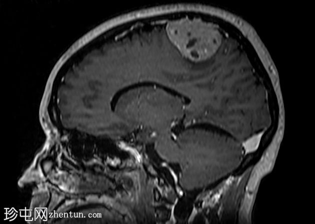 脑膜瘤 - 顶叶凸面