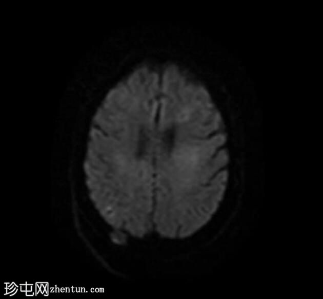 肺癌的脑和颅骨转移