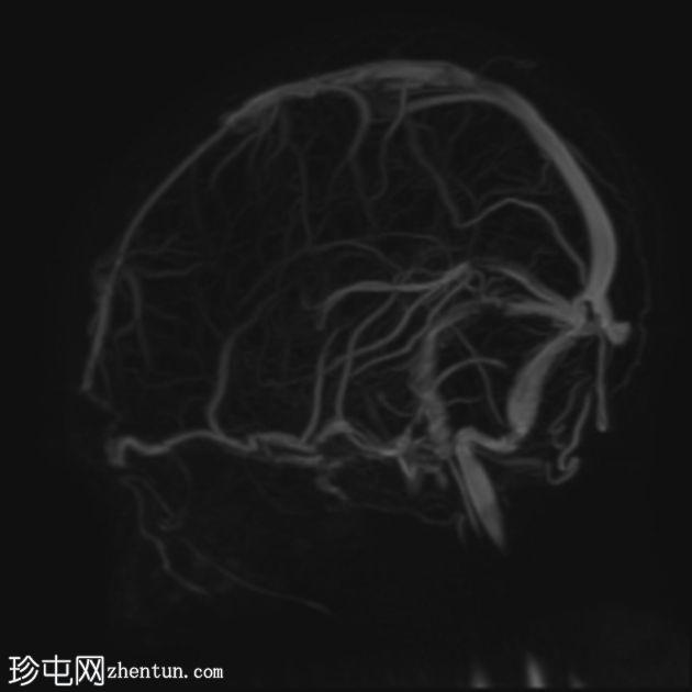 颅骨骨膜窦