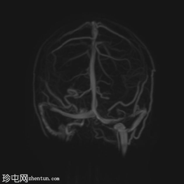 颅骨骨膜窦