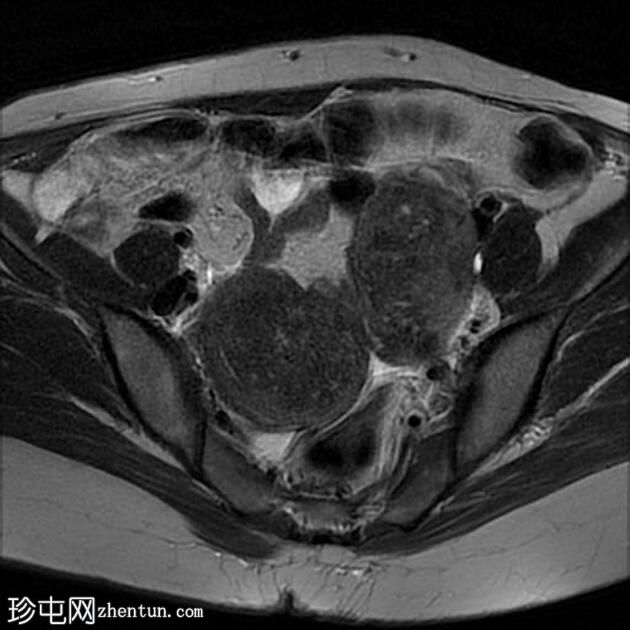 双子宫局灶性子宫腺肌病伴平滑肌瘤