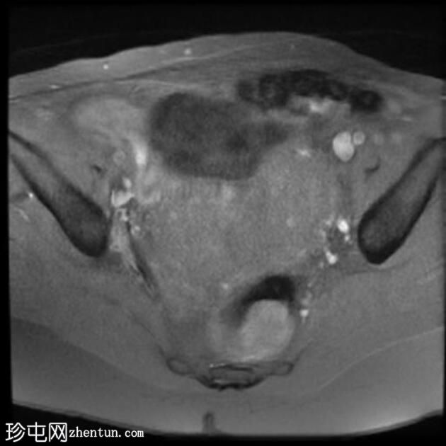 双子宫局灶性子宫腺肌病伴平滑肌瘤