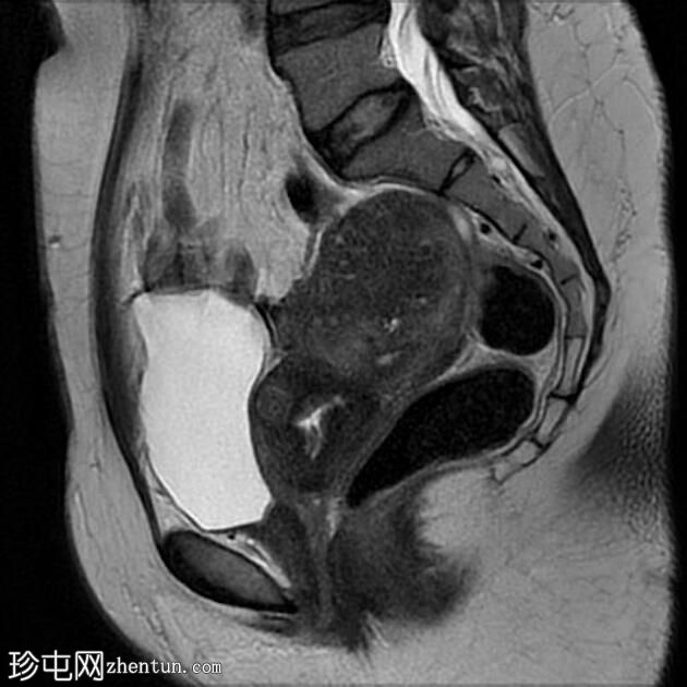 双子宫局灶性子宫腺肌病伴平滑肌瘤