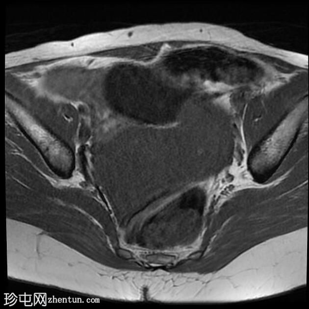 双子宫局灶性子宫腺肌病伴平滑肌瘤